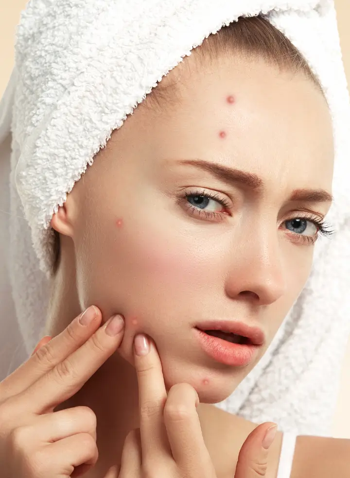 Acne, Pimples & Breakouts
